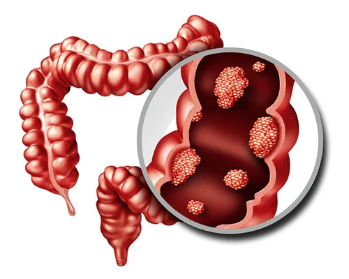 Anorectal Cancer Surgery in Surat