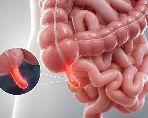 Appendix Surgery Specialist Surat