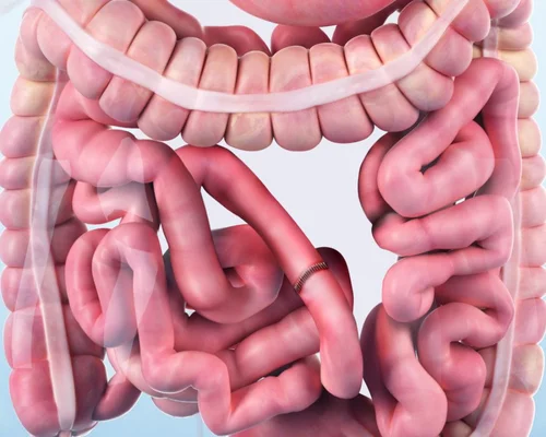 Advanced bowel surgery Surat