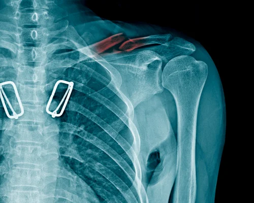 Affordable Humerus Surgery Surat