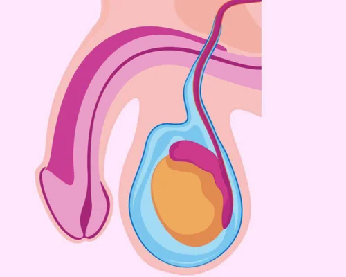 Affordable Hydrocele Treatment Surat