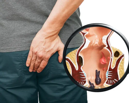 Piles and Fissure Treatment in Surat