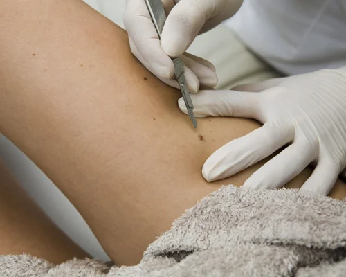 Book Biopsy Test Surat