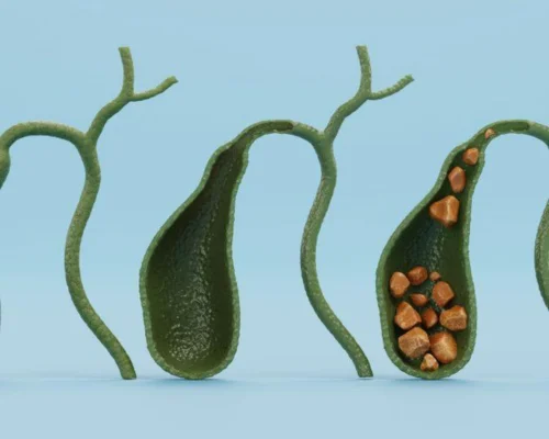 Book Gallbladder Surgery Doctor Surat