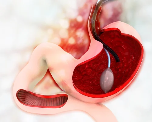 Advanced Stomach Surgery Surat