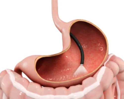 Endoscopy Test Surat