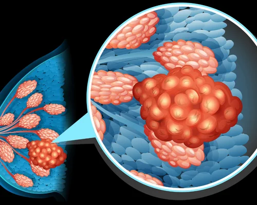 Breast Tumor Treatment Surat