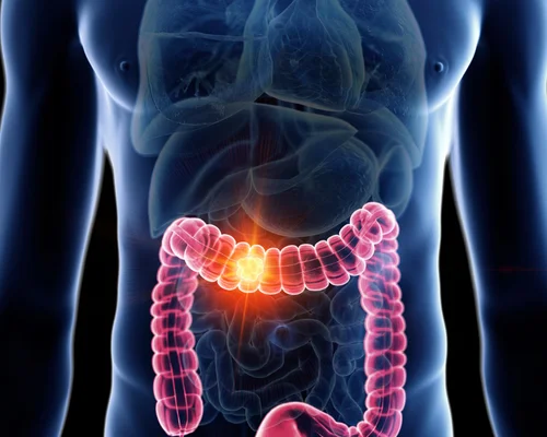 Best Colon Cancer Specialist Surat