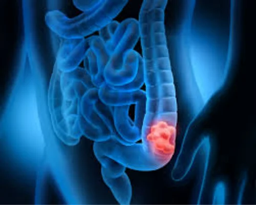 Colon Surgery Specialist Surat