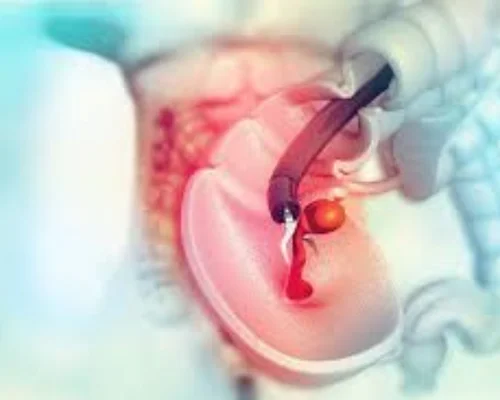 Colonoscopy Specialist Surat