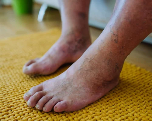 Diabetic Foot Care