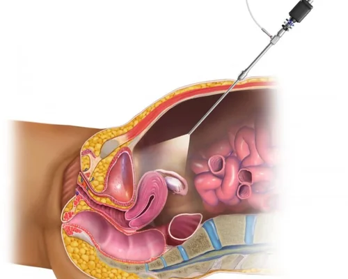 Advanced Laparoscopy Diagnosis in Surat