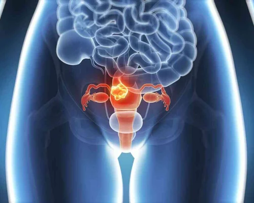 Painless Hysterectomy Treatment in Surat