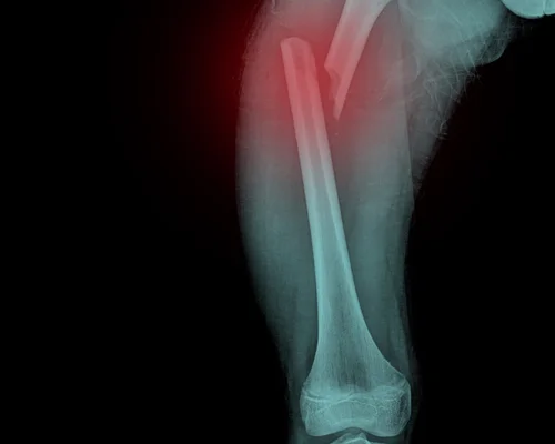 Best Femur Surgeon Surat
