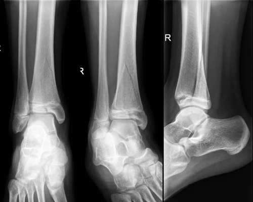 Fibula Surgery Surat