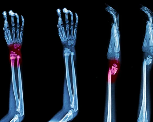 Best Fracture Surgeon Surat