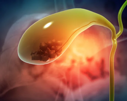 Biliary Surgery in Surat