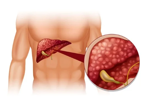 Gallbladder Surgery Specialist Surat