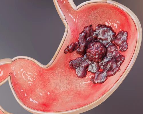 Gastric Cancer Specialist Surat