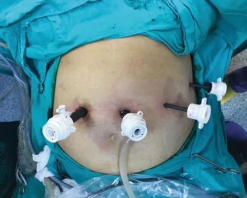 Gastric Cancer Treatment Surat
