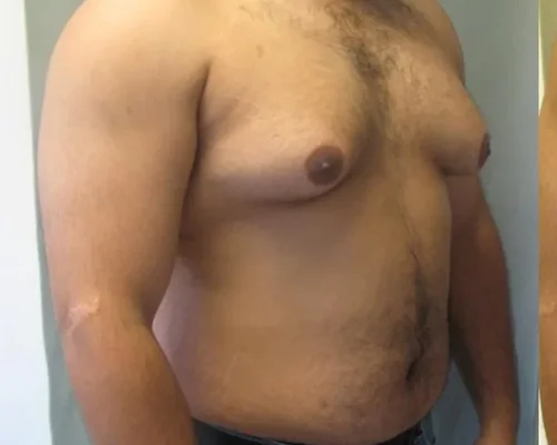 Male Breast Reduction Surat