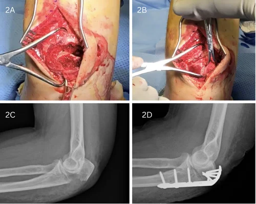 Humerus Surgery Surat