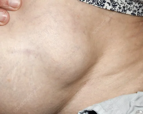 Incisional Hernia Treatment Surat
