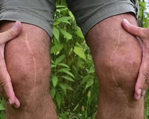 Knee Surgery Specialist Surat