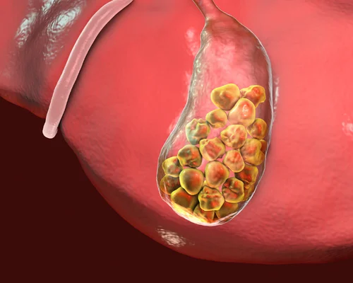 Laser Bladder Stone Treatment Surat