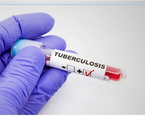 Lung TB Treatment Surat