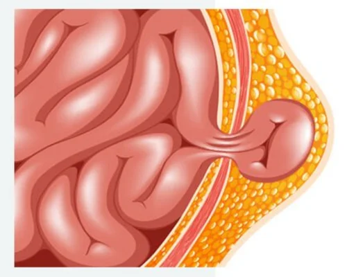 Multiple Hernia Doctor Surat