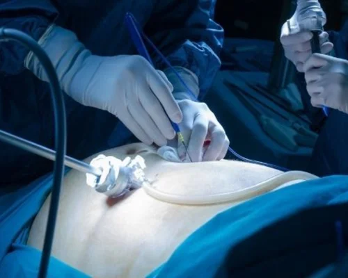 Multiple Hernia Surgery Surat