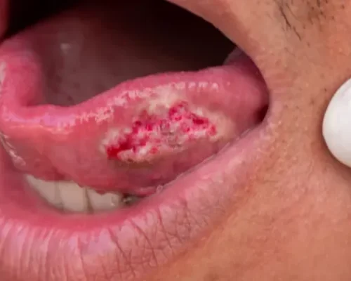 Oral Cancer Specialist Surat