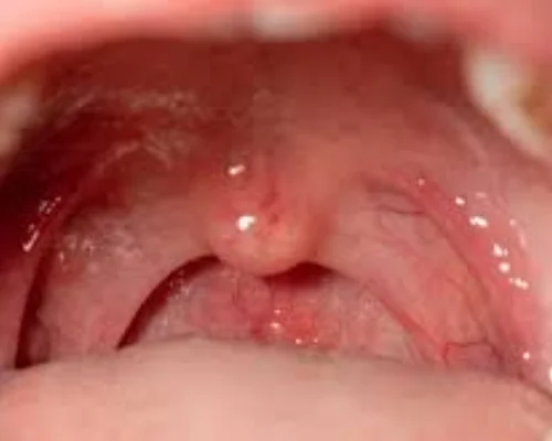 Oral Oncology Treatment Surat