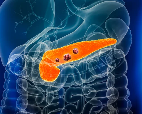 Pancreas Cancer Specialist Surat