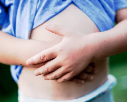Pediatric Hernia Treatment Surat