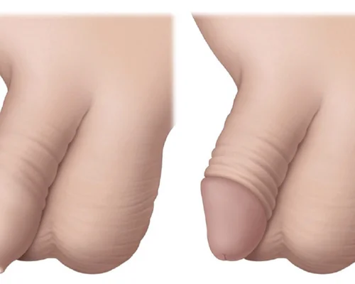 Phimosis Treatment Surat