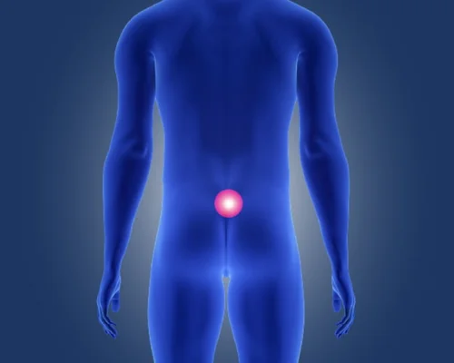 Pilonidal Sinus Specialist in Surat