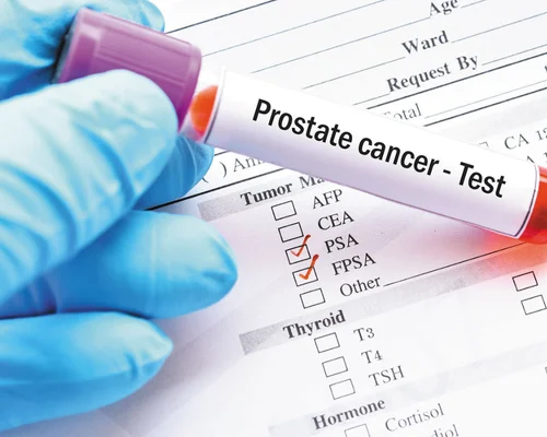 Prostate Cancer Specialist Surat