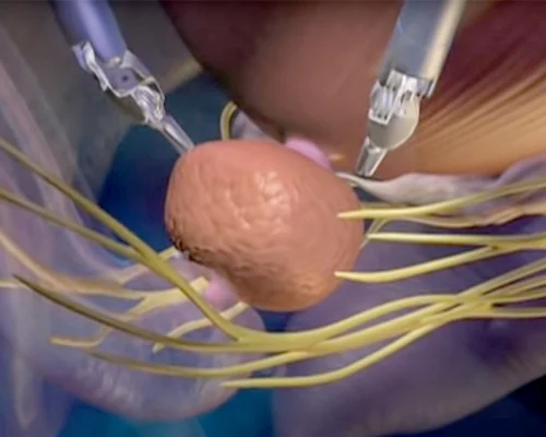 Prostatectomy Surgery Surat
