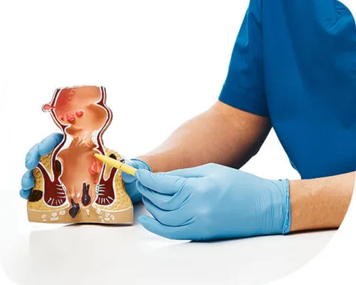 Safe Pilonidal Sinus Surgery Surat