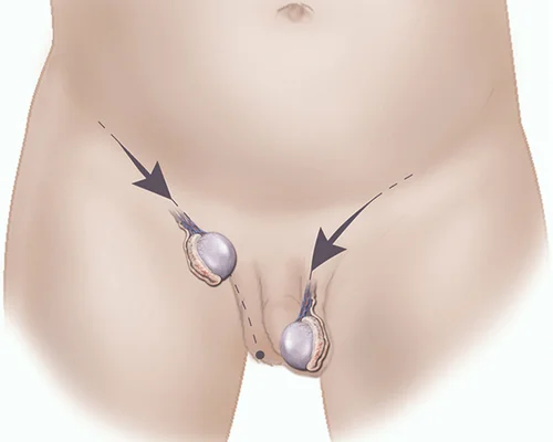Scrotal Surgery Doctor Surat