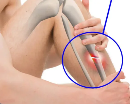 Tibia Fibula Fracture Specialist Surat