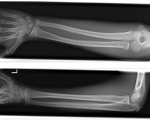 Radius Ulna Fracture Treatment Surat