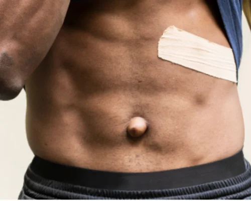 Umbilical Hernia Specialist Surat