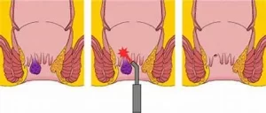 Laser Fissure Treatment in Surat