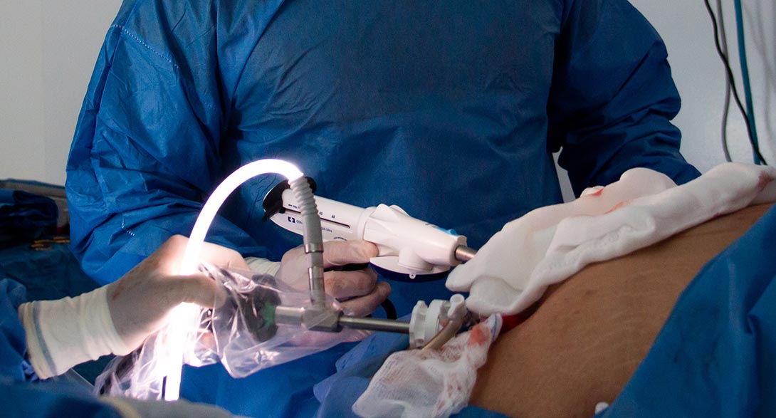 Appendix Surgery Expert in Surat