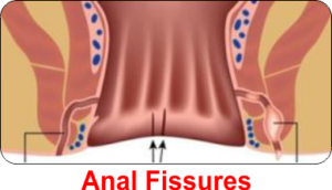 Top Fissure Treatment Specialist in Surat