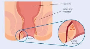 Best Fistula Surgeon Surat Best Fistula Surgeon Surat