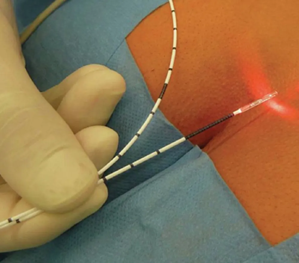 laser fistula treatment in Surat